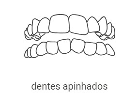 Apinhamentos (falta espaço suficiente na arcada dentária)