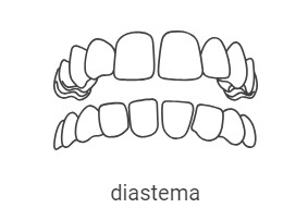 Espaços demasiados entre os dentes