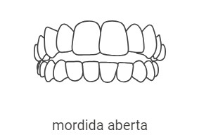 Dentes da frente superiores e inferiores não se tocam