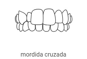 Dentes da arcada superior não se encaixam corretamente nos da arcada inferior
