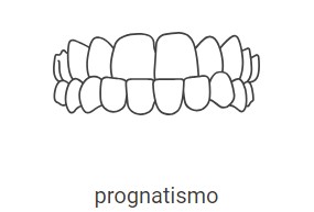 Dentes da frente inferiores cobrem quase totalmente os dentes superiores
